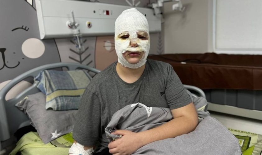 Вибухівка з TikTok - у Львові троє школярів зазнали хімічних опіків обличчя 2