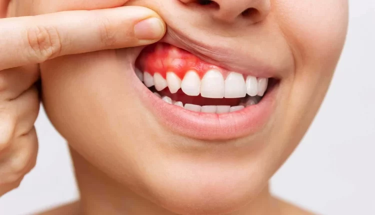 Гіпертрофічний гінгівіт: особливості захворювання та сучасні методи лікування 1